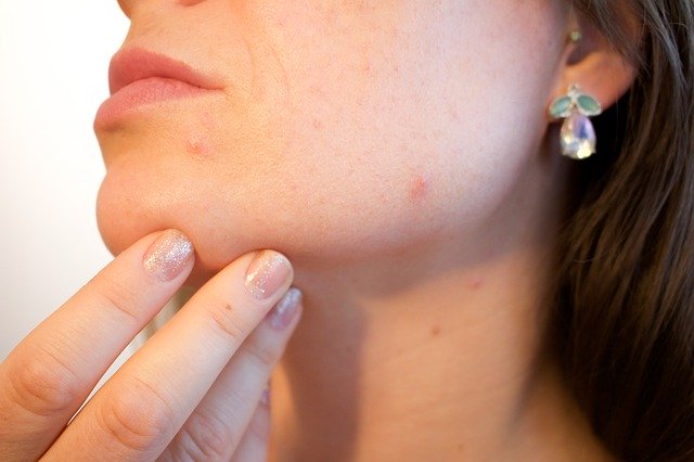【知っておきたい】簡単にできるメンズニキビの隠し方